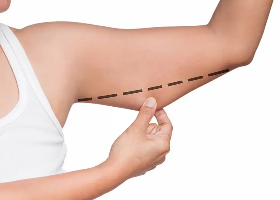 Chirurgie du lifting des bras