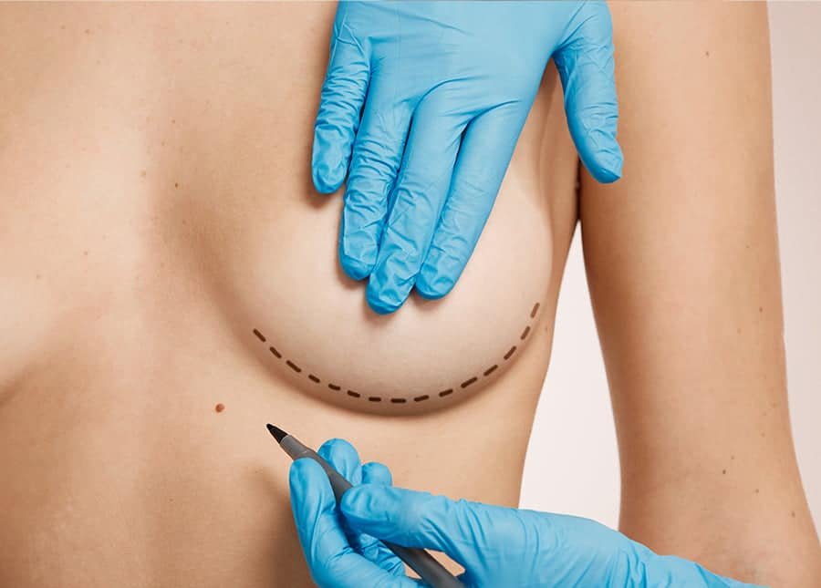Chirurgie de Réduction du Mamelon