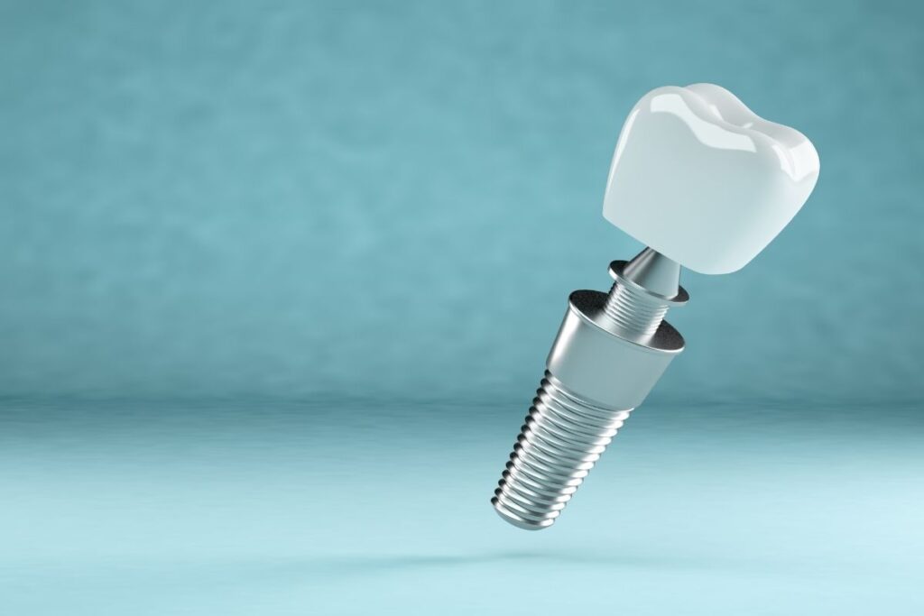 Implant Dentaires Tous sur 6