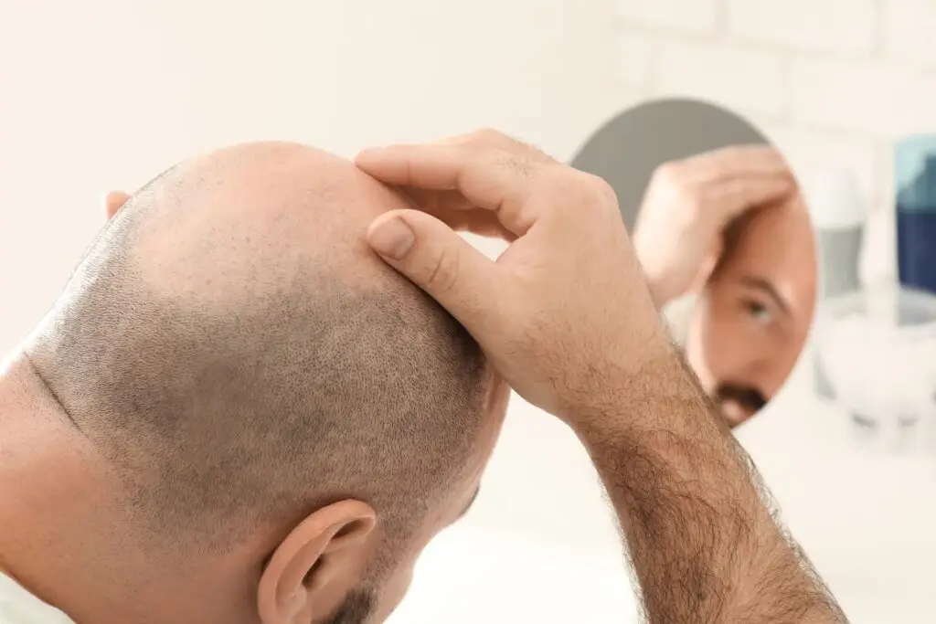 Greffes De Cheveux