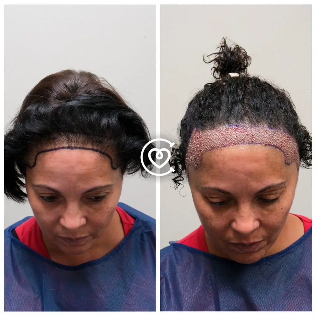 Transplantation de cheveux pour femmes