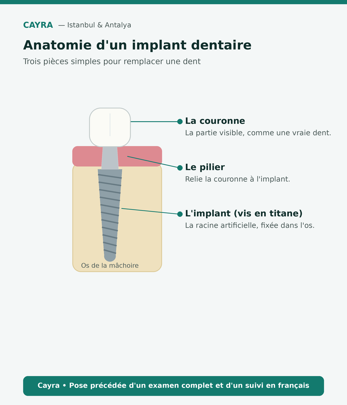 anatomie d'un implant dentaire : couronne, pilier et vis en titane — Cayra 