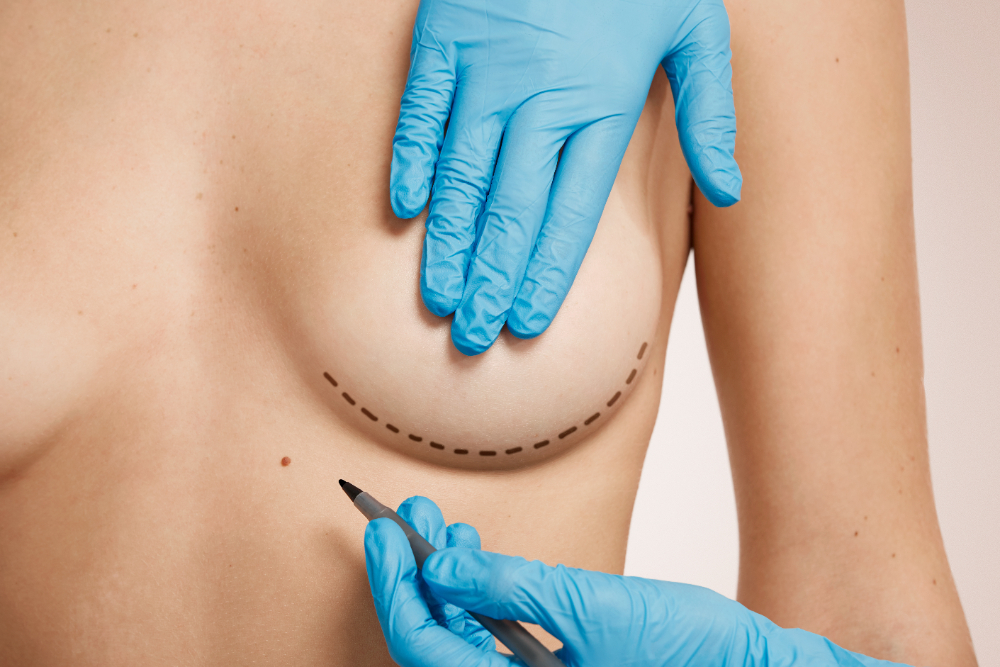 cicatrices chirurgie mammaire
