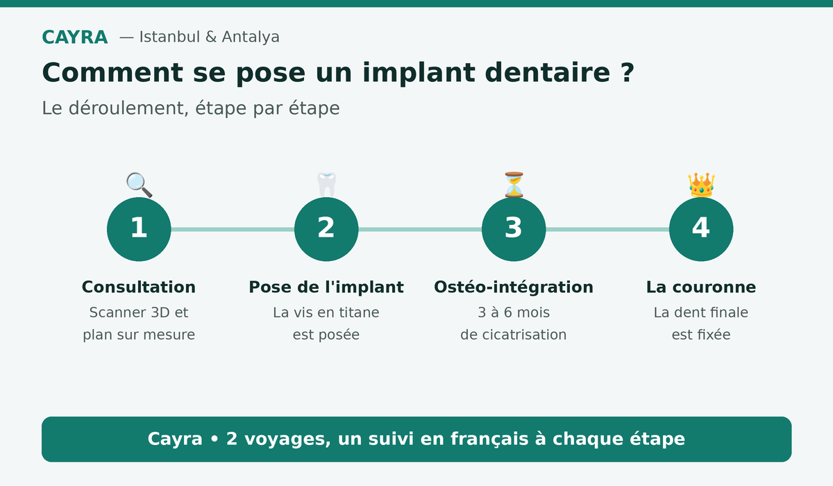 implant dentaire : les étapes de la pose, de la consultation à la couronne — Cayra