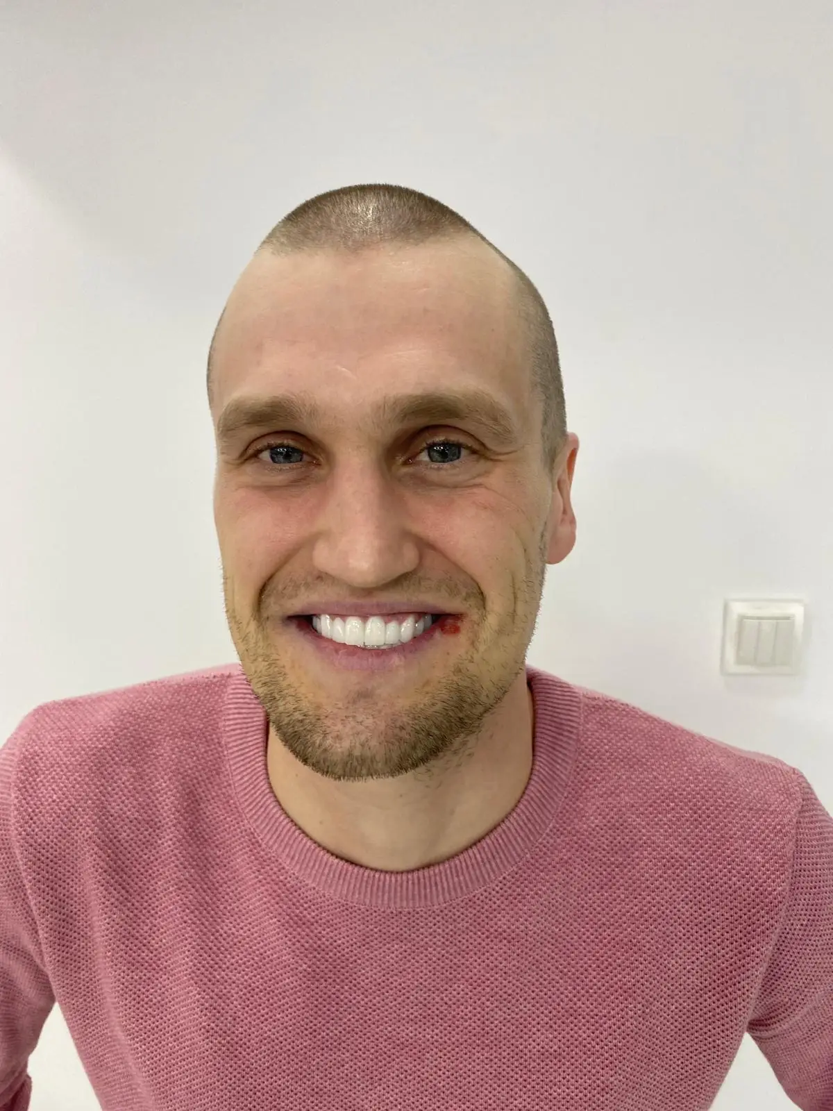 4500 témoignages de patients ayant subi une greffe de cheveux