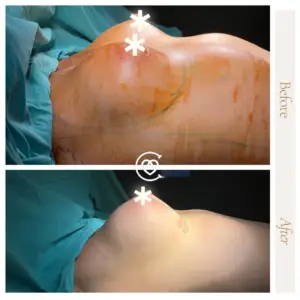 Photo avant et après implants mammaires.