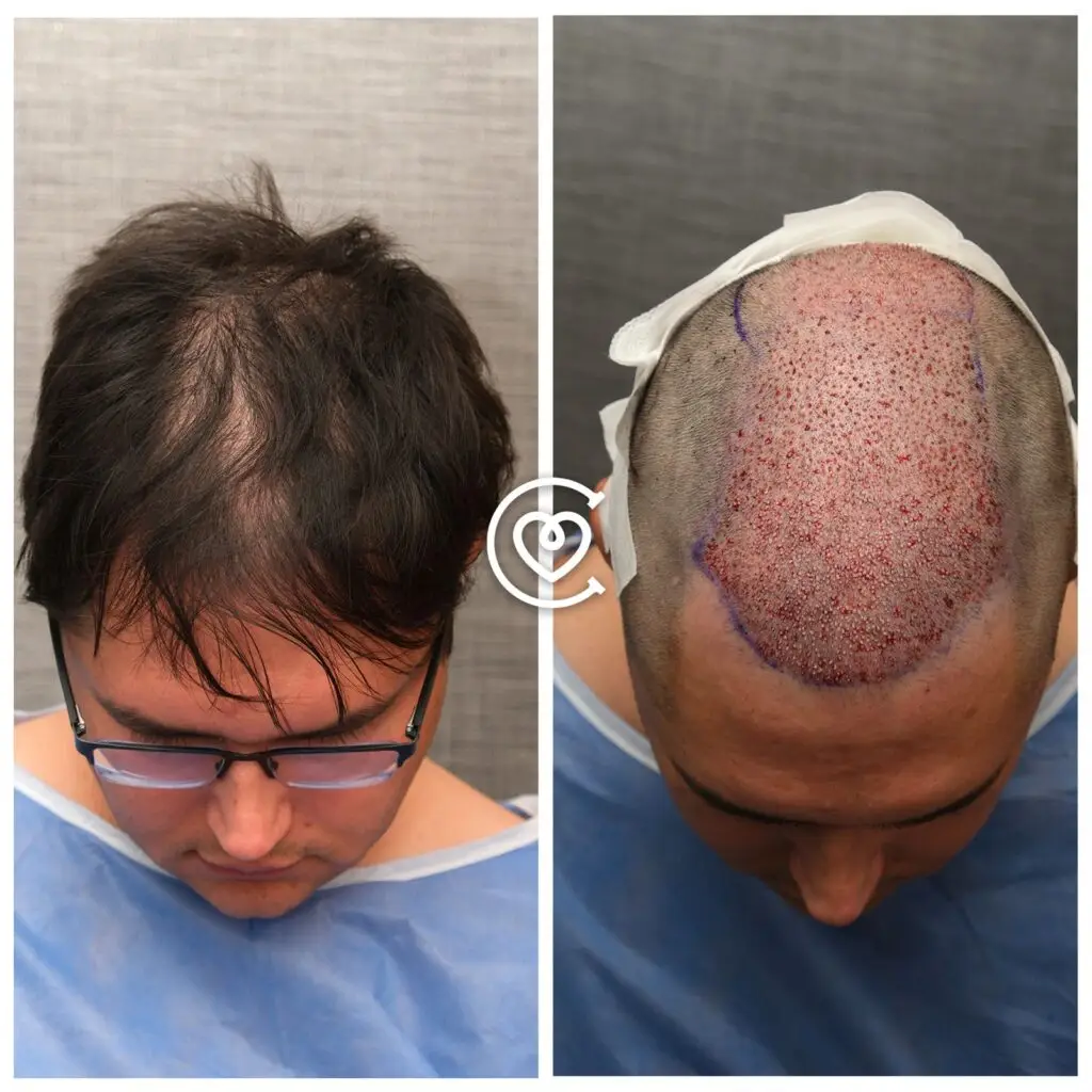 Photo avant après greffe de cheveux en Turquie