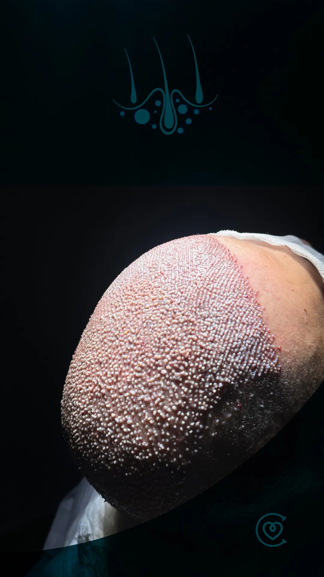 Extraction d'unités folliculaires (FUE)