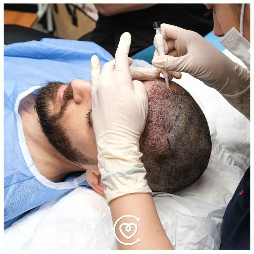 Greffe de cheveux DHI | Implantation capillaire directe