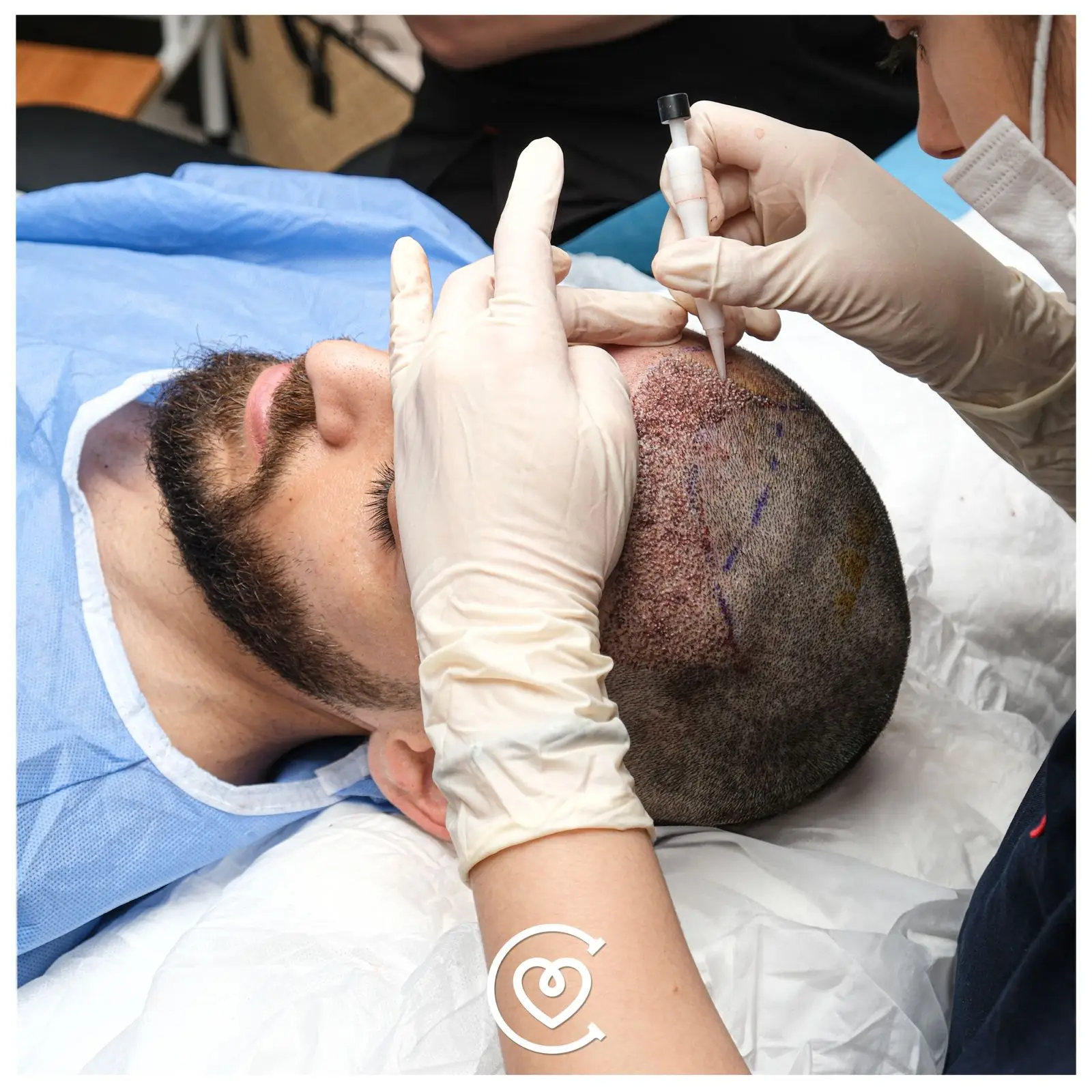 Greffe de Cheveux DHI