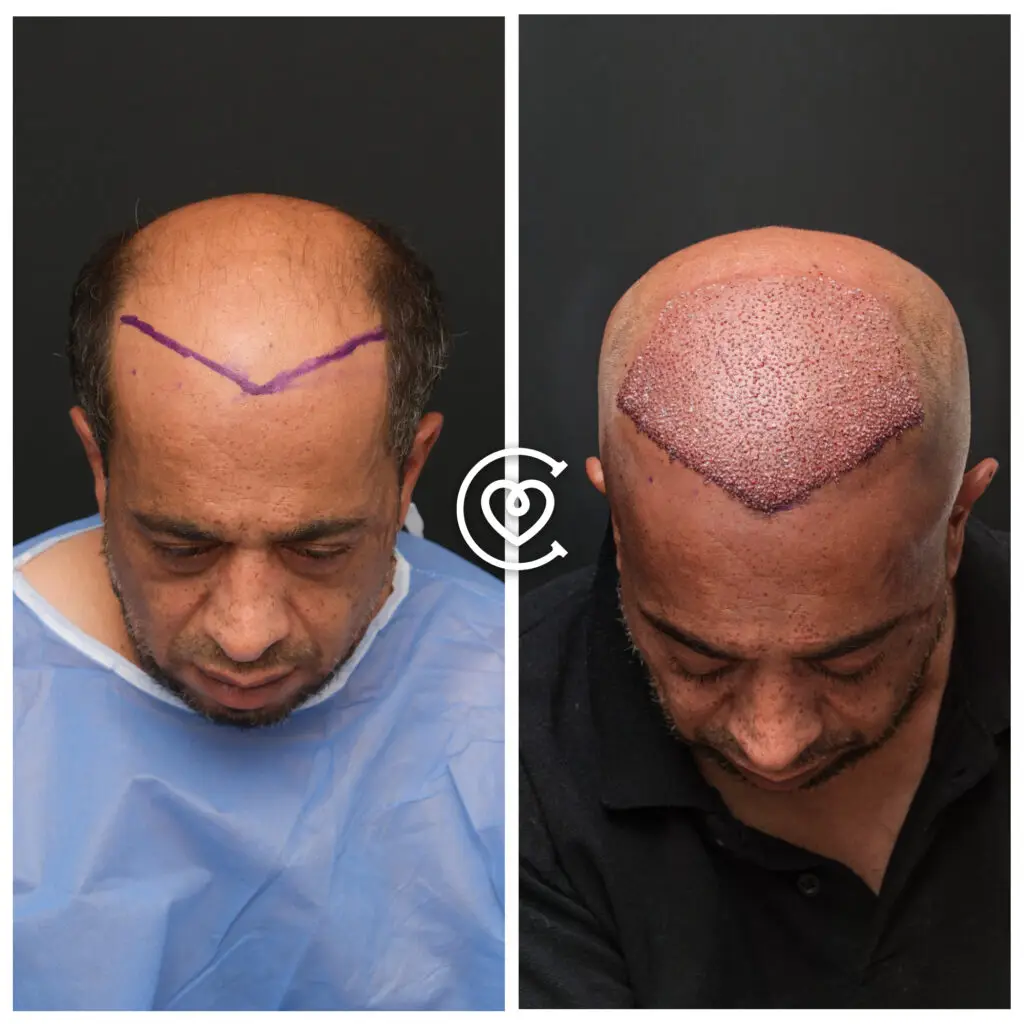 Photo avant après greffe de cheveux