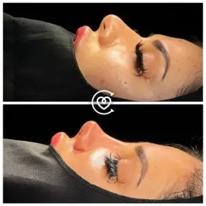 Photo avant et après rhinoplastie.