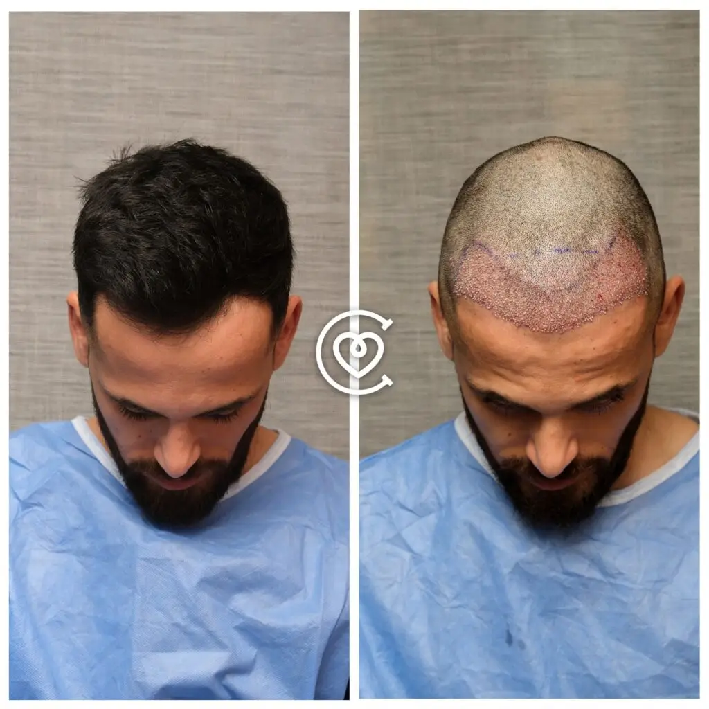 Photo avant après greffe de cheveux