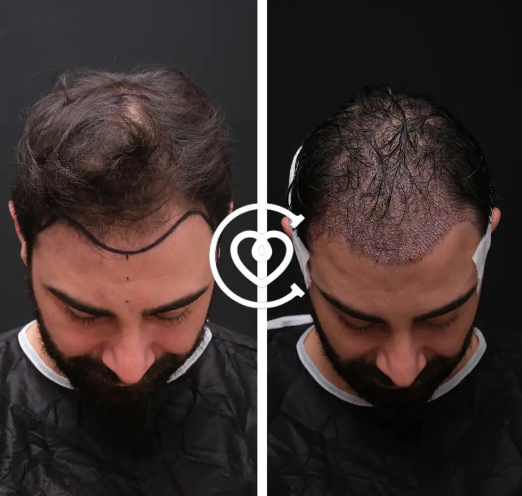 Photo avant après greffe de cheveux en Turquie