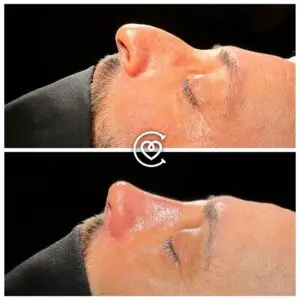 Rhinoplastie photo avant et après.