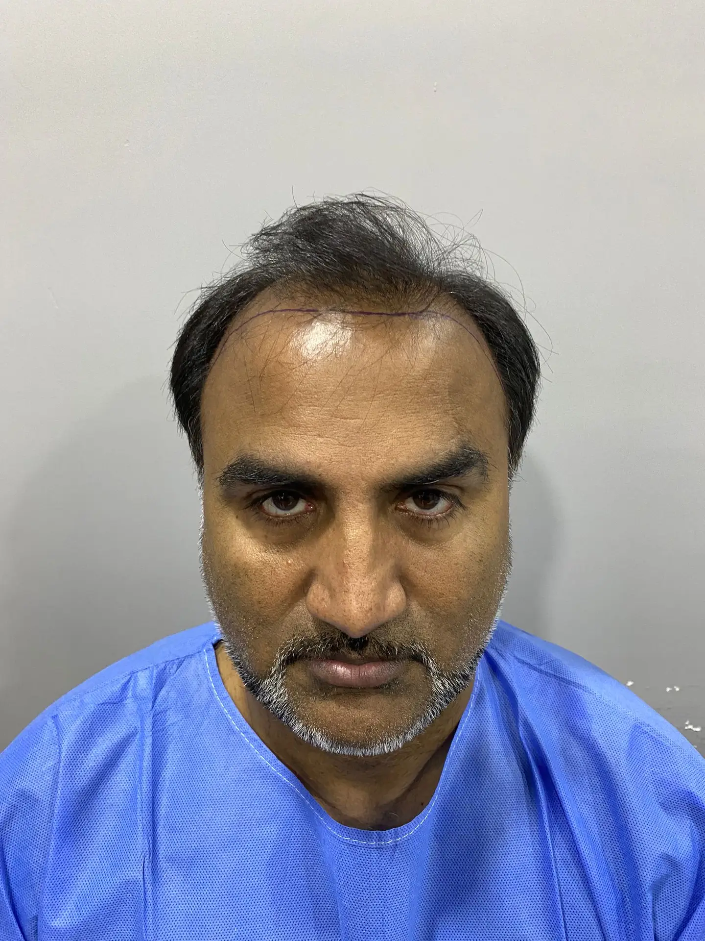 Témoignages de patients ayant subi une greffe de cheveux