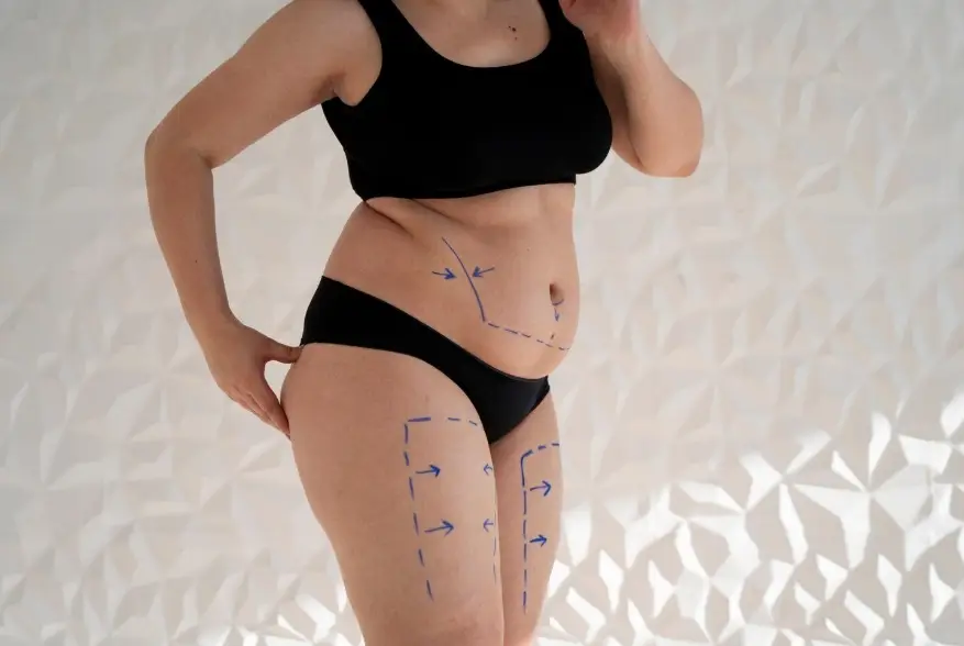 Liposuccion ou régime