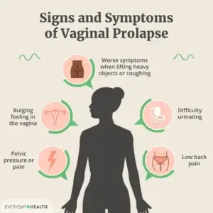 Symptômes du prolapsus vaginal