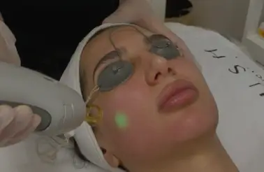 laser pour acne