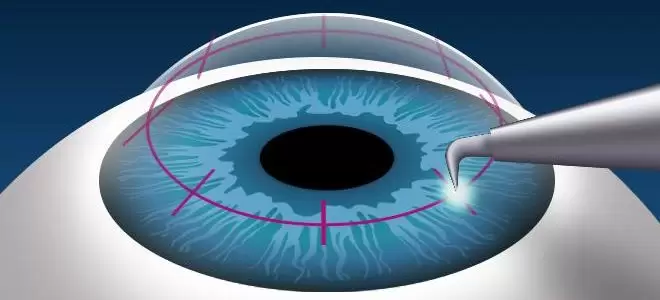 corneal transplant e1587255558122.jpg