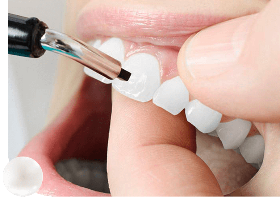 kozmetik bonding tedavisi nasil yapilir