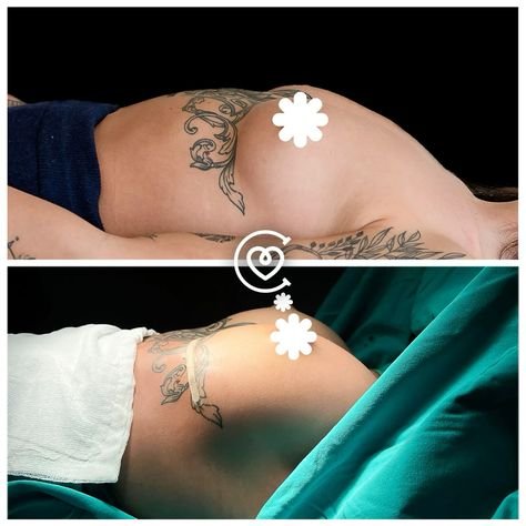chirurgie du sein