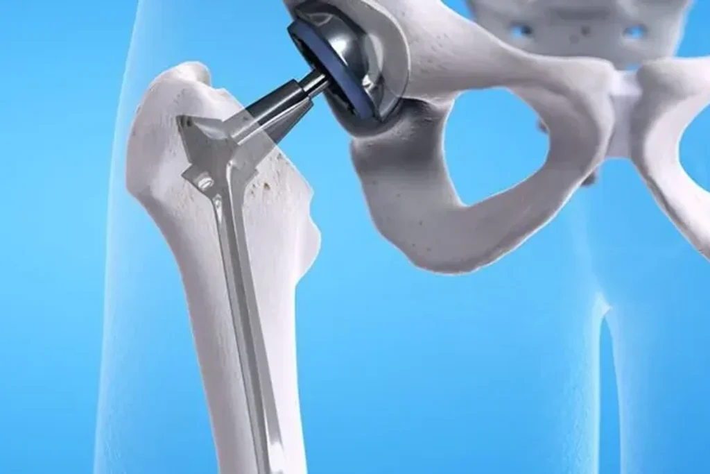 kalca protezi ameliyati sonrasi 03