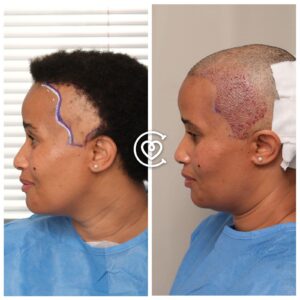 greffe capillaire VIH