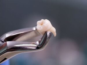 Dents de sagesse Turquie : 7 raisons de choisir l’extraction
