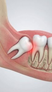 Dents de sagesse Turquie : 7 raisons de choisir l’extraction