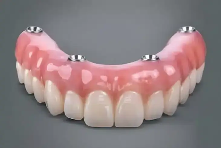 4 iu dantu implantai.webp