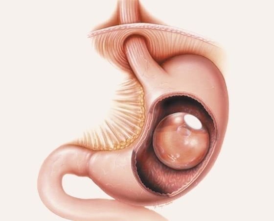 Ballon gastrique 12 mois Turquie : avantages minceur clés