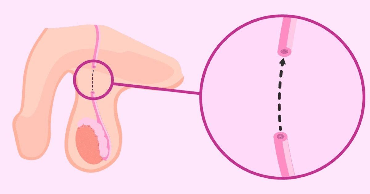 Vasectomie : 10 Points Essentiels à Connaître
