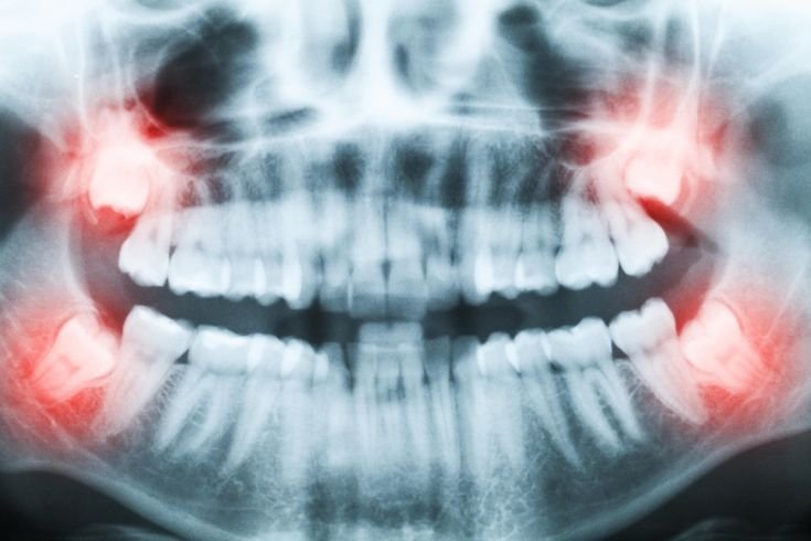 Dents de sagesse Turquie : 7 raisons de choisir l’extraction