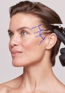 Lifting médio-facial Turquie : 5 Points Clés