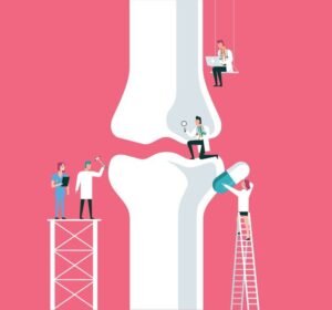 Remplacement du genou : 7 points essentiels à savoir