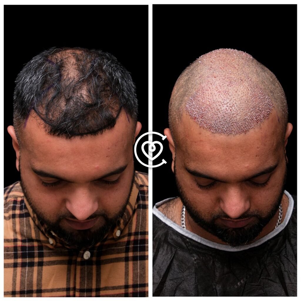 application greffe cheveux Turquie
