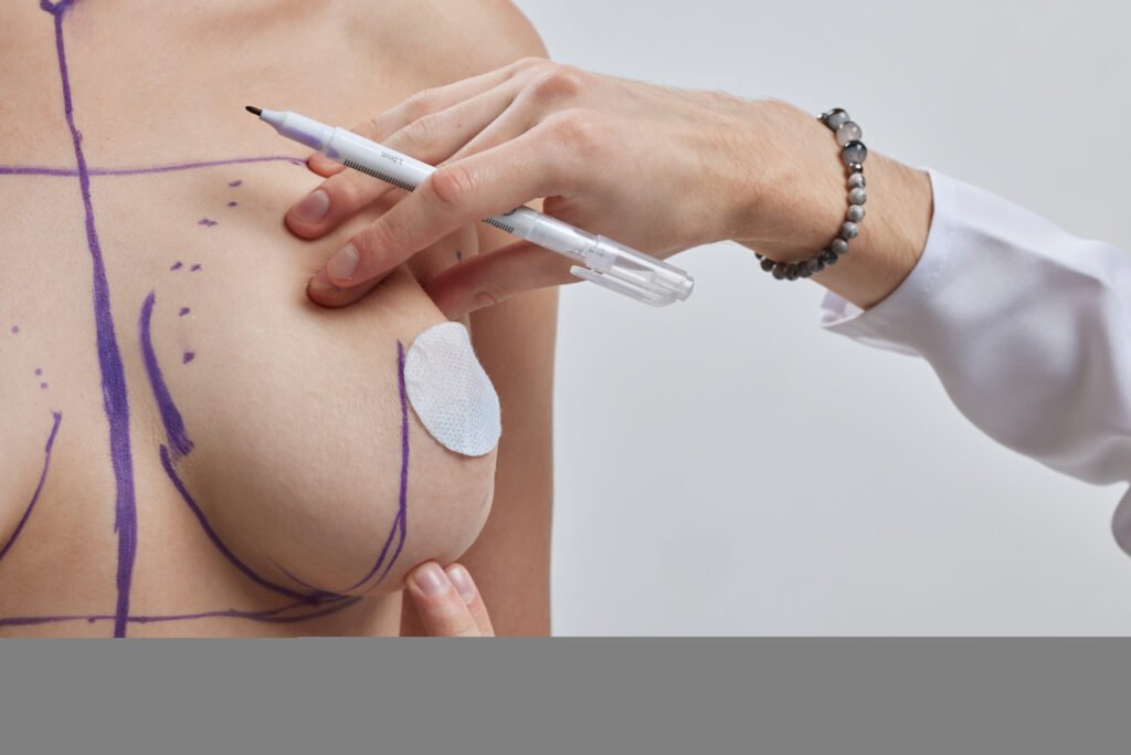 Augmentation des seins avec graisse autologue