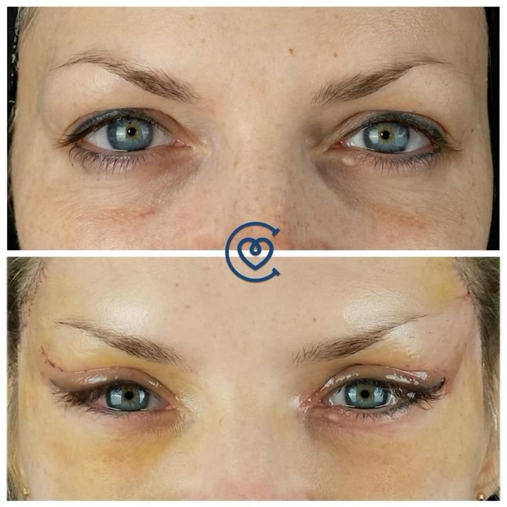 Résultats après chirurgie Cat Eye avec regard plus défini