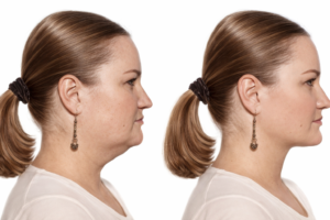 Liposuccion du cou en Turquie : Prix et Résultats