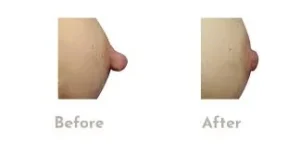 Réduction des Mamelons : Guide Complet 2026.