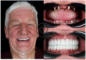 Implants zygomatiques en Turquie : 7 raisons de choisir cette solution