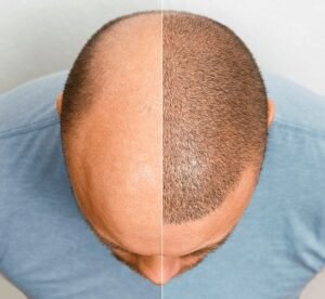 scalp micropigmentation before after turkey