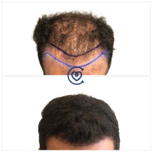 Greffe de cheveux au saphir avant et après