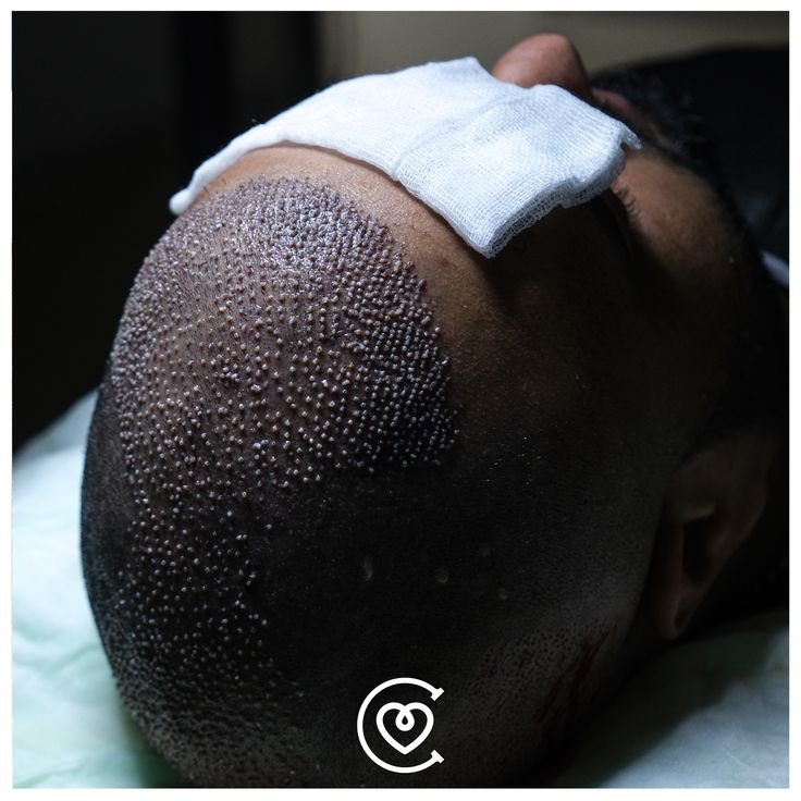 conception d’une ligne frontale naturelle avec la méthode dhi