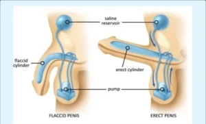 Dysfonction érectile en Turquie : Prix et Traitement 2026