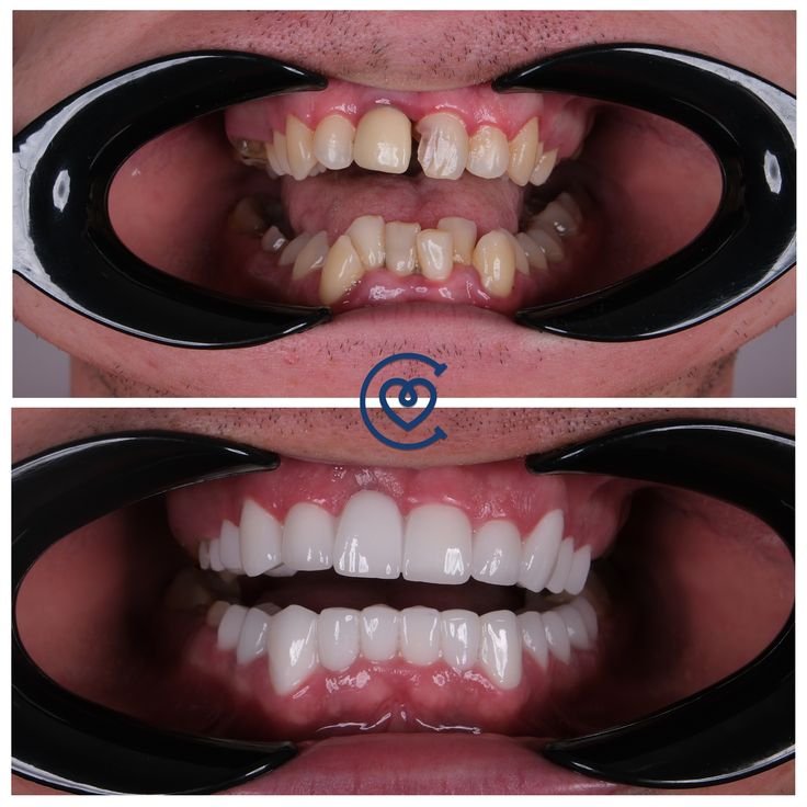 facettes dentaires esthétiques pour un sourire parfait chez cayra clinics