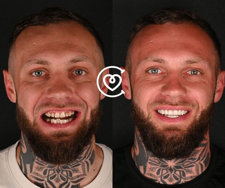 facettes dentaires personnalisées pour un sourire harmonieux
