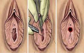 Hyménoplastie en Turquie : 5 Avantages Clés