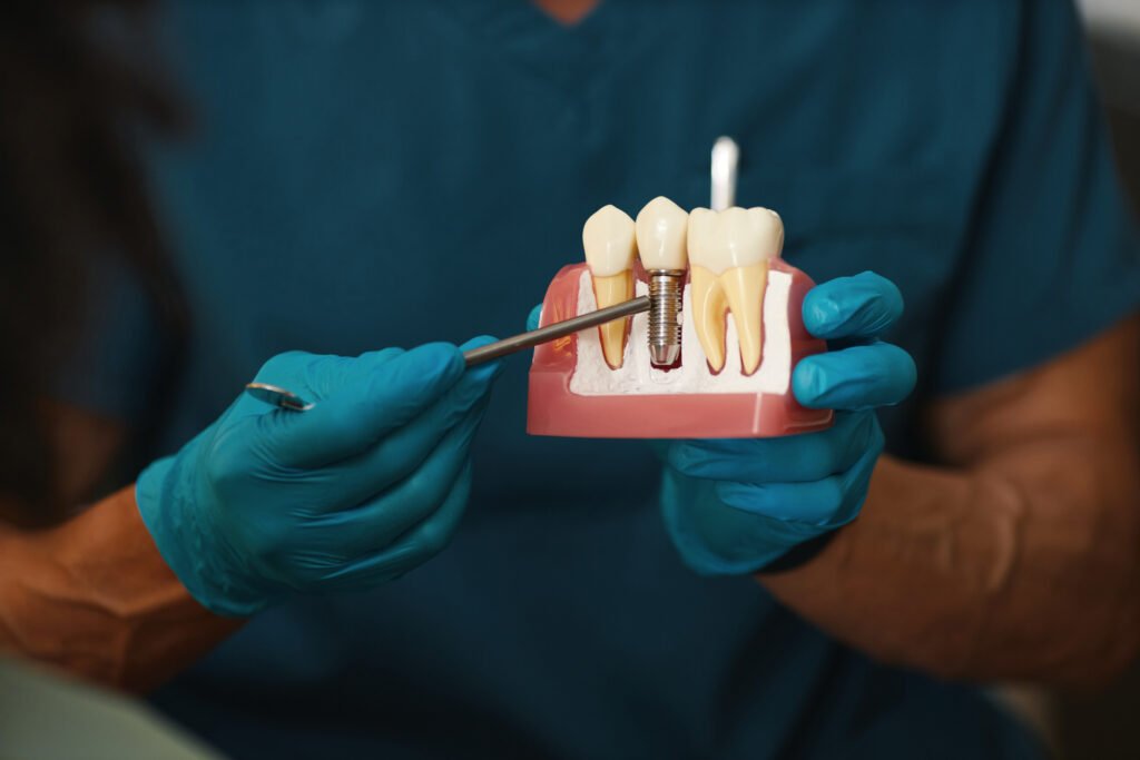 Implants All-on-4 réalisés par des spécialistes pour un sourire durable